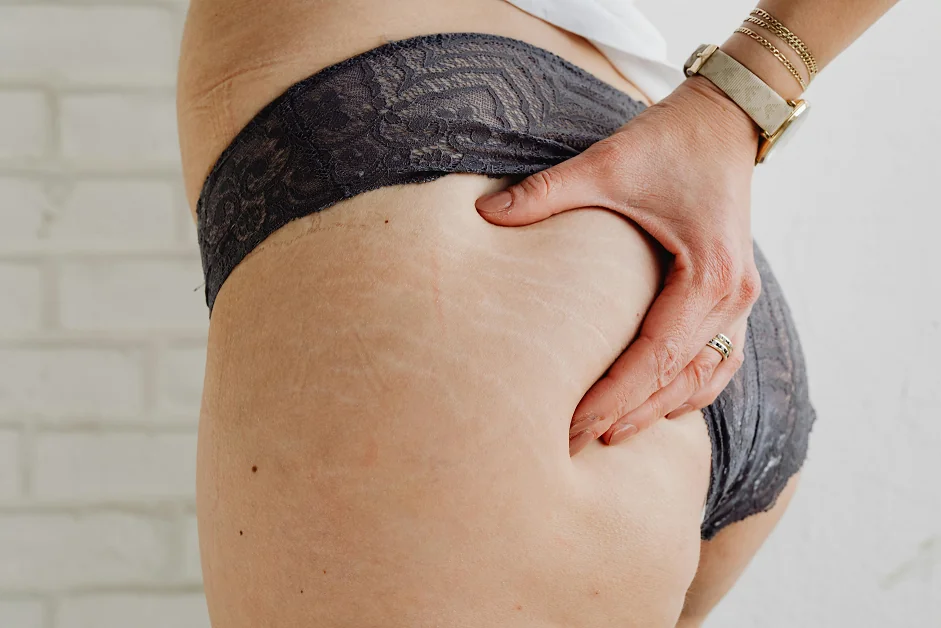Redukcja blizn i rozstępów mezoterapia mikroigłowa Exceed Boska Beauty Clinic Łódź