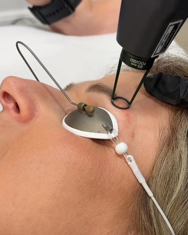 Usuwanie makijażu permanentnego laserem Q-Switch Łódź Boska Beauty Clinic